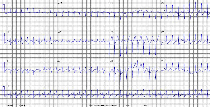 A normal heart rate is 60 to 100 beats per minute. Mcgill Ekg Learning Project