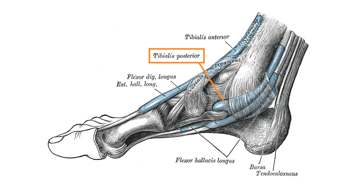 They are often associated with activities requiring increased pressure on the ball of the foot, such as running, basketball, football, golf, tennis and ballet. Posterior Tibial Tendon Dysfunction And Acquired Flat Foot Deformity