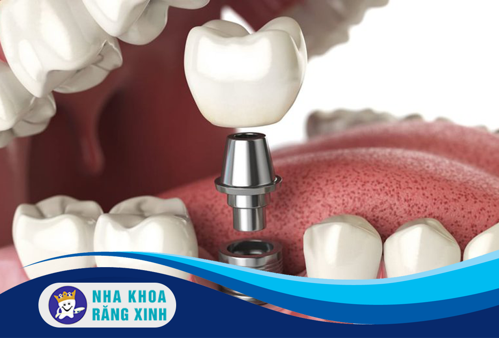 phụ nữ mang thai có cắm ghép implant được không