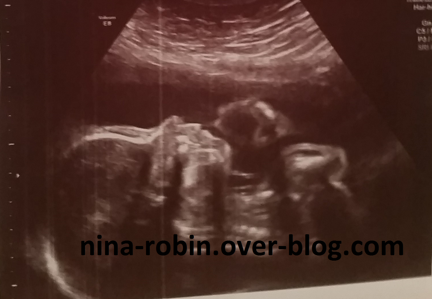 Les Plus Selectionnes Echographie 3d Bebe Gros Nez Elcampodelamentiraa