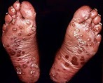 Foot Cancer Symptoms Pictures - Spotting Melanoma Cancer and Symptoms (with Pictures ... : Do you know what a staph infection is?