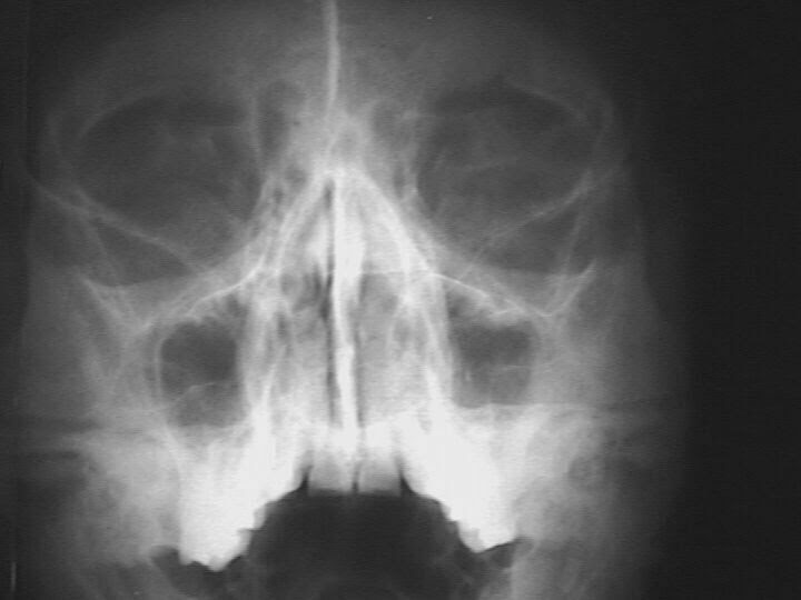 Weeks 4 Sinusitis Acute
