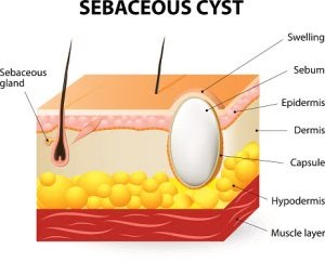 Sebaceous Cyst dan kaedah alternatif perawatan 