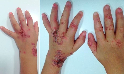 Toddler left covered in a rash after catching herpes from her father | Daily Mail Online