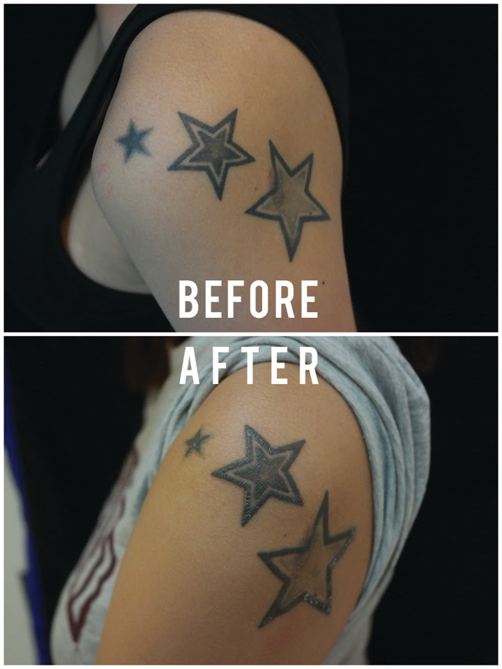 But you will be left with marks or scars. To Rub Out The Stars Quick Cheap But Not Pain Free Tattoo Removal