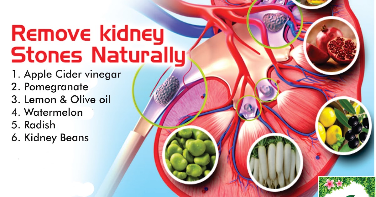 Kidney Stones Treatment Best kidneyoi