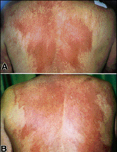 In the united states, it's estimated that doctors diagnose over 100,000 new skin cancer cases each year. John Libbey Eurotext European Journal Of Dermatology Skin Metastasis Of Breast Cancer Clinically Undistinguished From Amyopathic Dermatomyositis