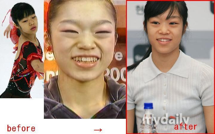 70以上 韓国 俳優 整形 画像 Bettyfigueroajp