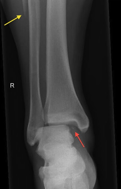 Maisonneuve fracture includes a wide range of injuries both to bone and ligamentous structures of the ankle. Maisonneuve Fracture Radiology At St Vincent S University Hospital