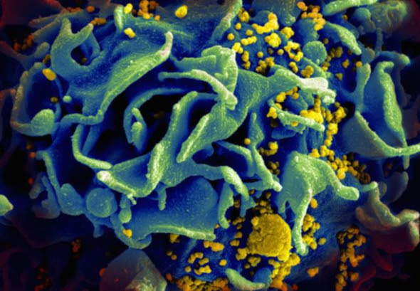 A micrograph of an HIV-infected T cell.