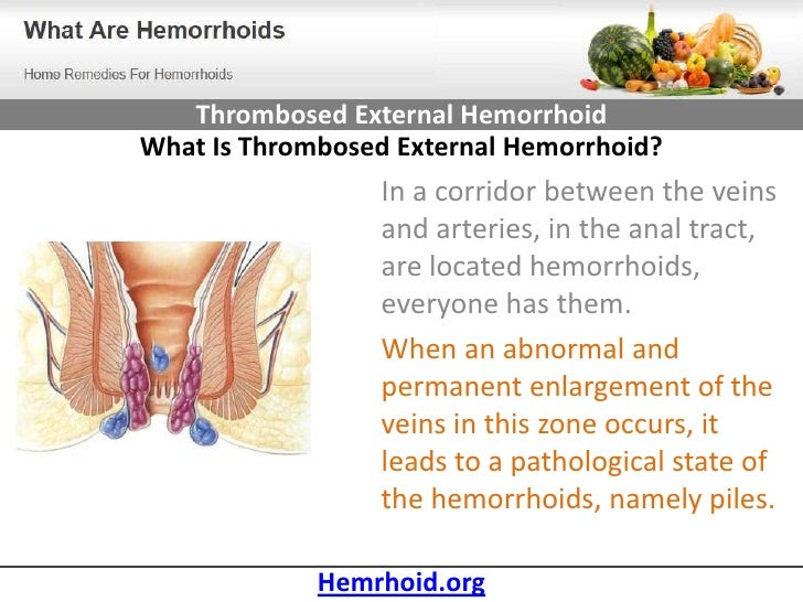 25 Inspirational Thrombosed Hemorrhoid Relief