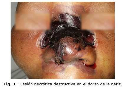 Una alteración de ese equilibro puede provocar una. Mucormicosis Rinocerebral Soares Revista Cubana De Otorrinolaringologia Y Cirugia De Cabeza Y Cuello