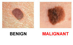 These spots can be flat or raised and can bleed easily. Skin Cancer Awareness Melanoma Valley Healthcare System