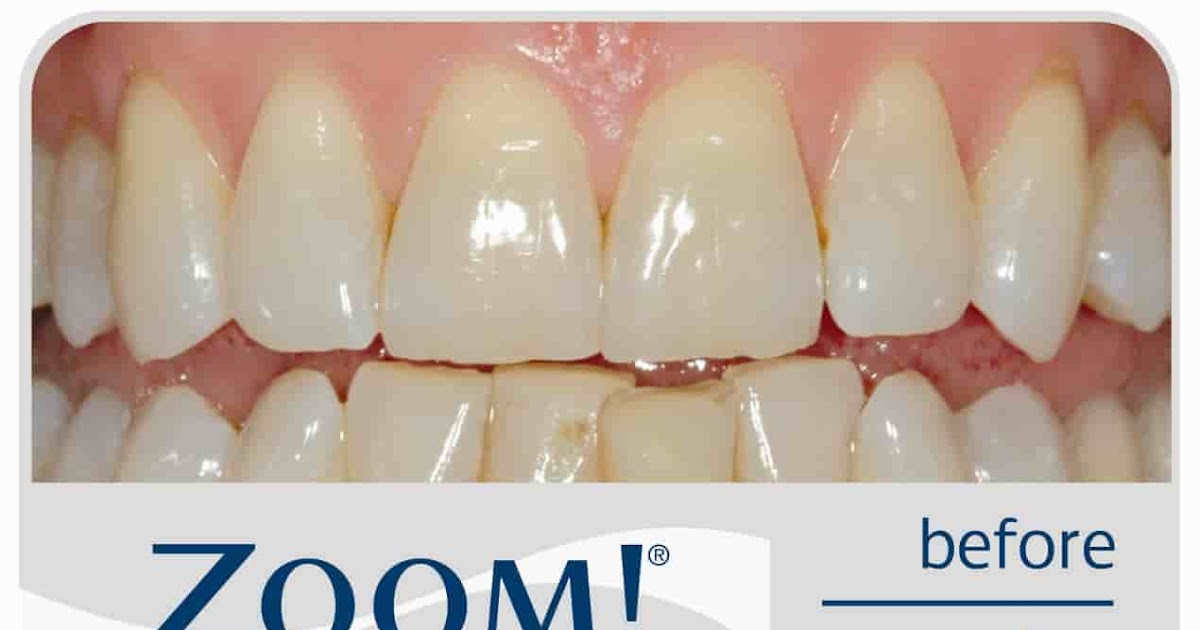 Long does laser teeth whitening last