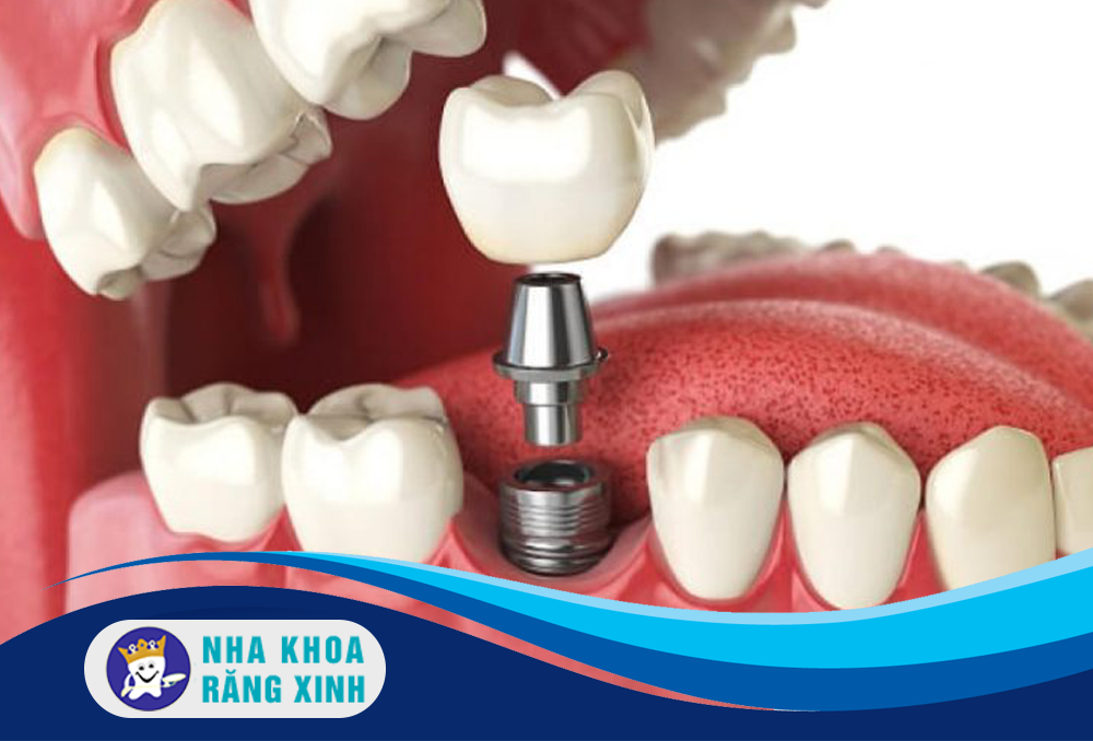 cắm ghép implant có đau không