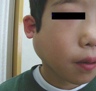 これまでで最高の子供 耳の下 腫れ 熱なし かわいい子供たちの画像