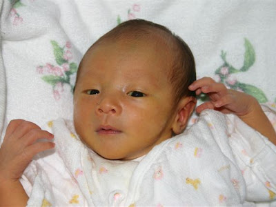 コンプリート！ 黄疸 症状 写真 赤ちゃん 462067-黄疸 症状 写真 赤ちゃん
