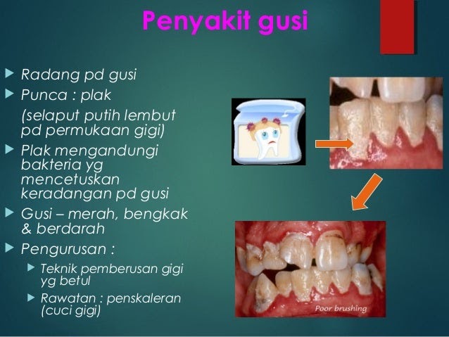 Ubat Surut Bengkak Gusi - Kerja Koso