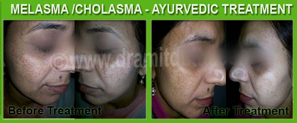 Let's discuss pigmentation on the face, melasma, and hyperpigmentation including its causes. Melasma Dr Amit Dutta Best Ayurvedic Doctor Skin Specialist In Punjab India