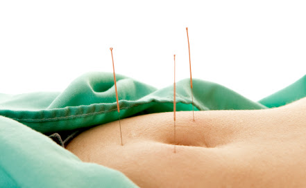 Acupuncture needles