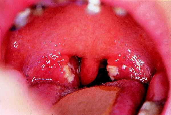 Schätzungsweise 95 prozent aller europäer infizieren sich bis zum 30. Mononucleosis Infectiosa Pfeiffer Sches Drusenfieber