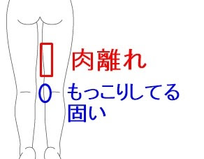 70以上 太もも 内側 痛み 太股 内側 痛み ズキズキ 代