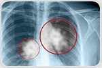 Study examines unnecessary medicine use in patients with advanced lung cancer