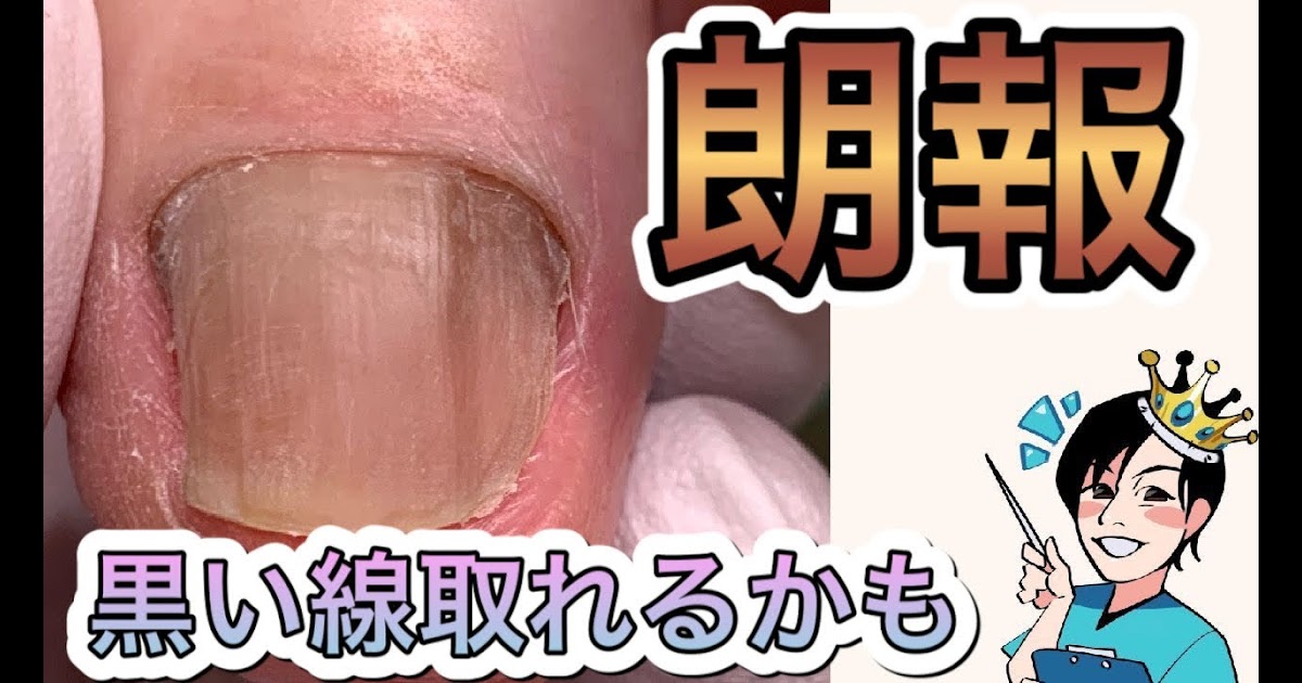 最も選択された 爪 黒い 線 消す 爪 黒い線 消す
