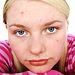 Acne Diet Dos and Don'ts