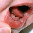 Normal Roof Of Mouth Baby : 15 Must Knows About The Baby S Mouth From Tongue Ties To Teeth - (photosinhouse16@gmail.com) dentaltwins® brooklyn dental chat | ask a dentist u2022 view.