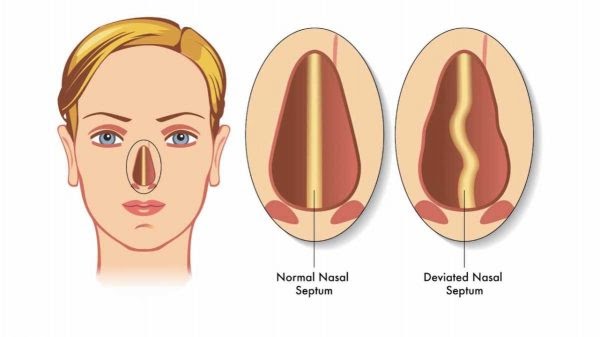 Ubat Untuk Allergic Rhinitis - Kerja Kosong A