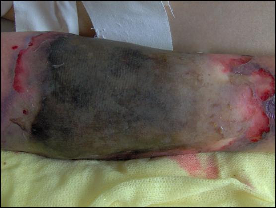 Es una infección micótica (hongos) de los senos paranasales, el cerebro o los pulmones. Zigomicosis Revista Argentina De Dermatologia