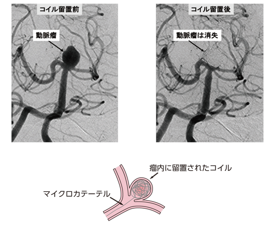 コイル イラスト コイル 手 イラスト