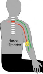 A nerve transfer bypasses the zone of a spinal cord injury (C7). Functional nerves (green) that are under volitional control are rerouted (yellow) to nerves (red) that come off below the spinal cord injury. (credit: Washington University in St. Louis)