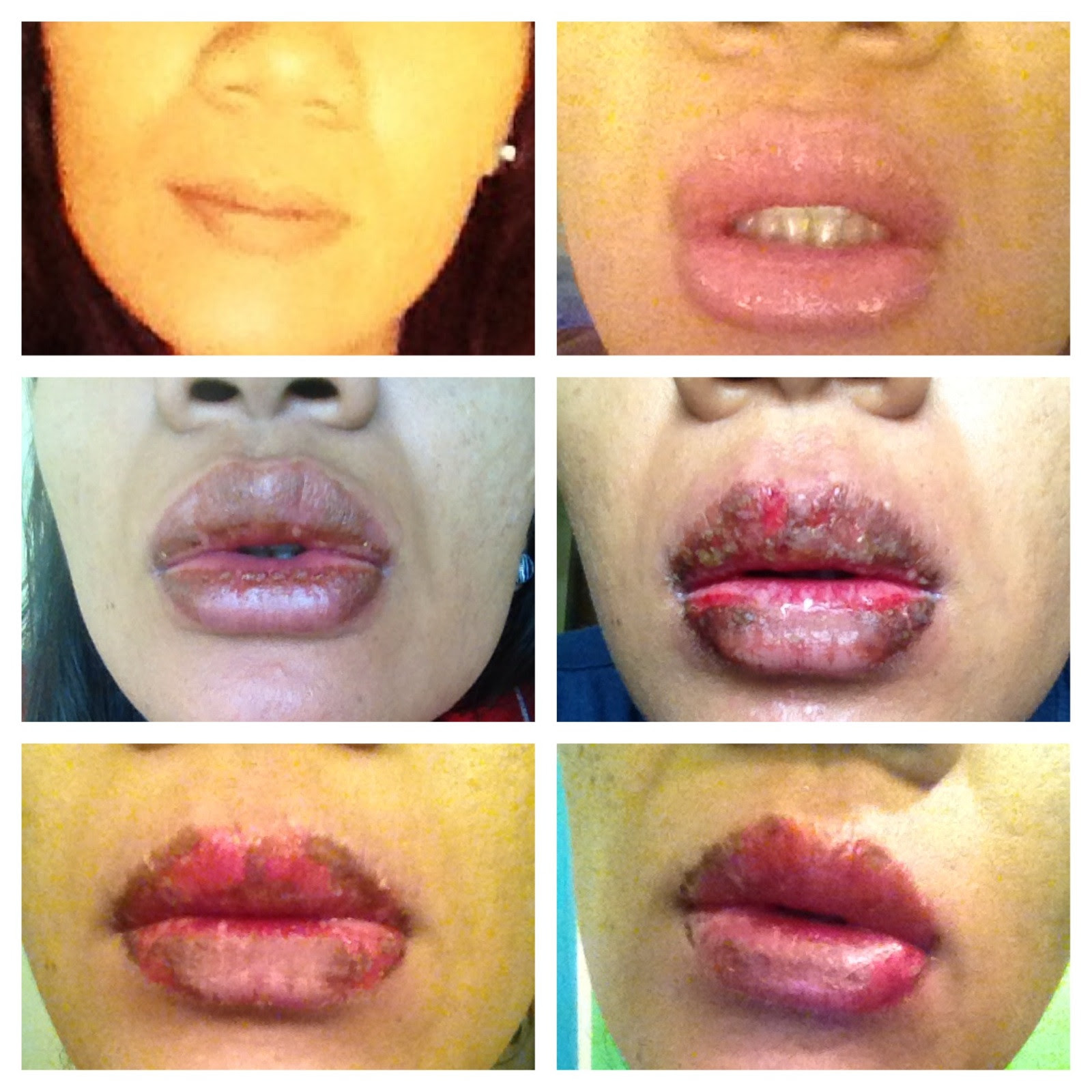 Eos Lip Balm Rash Cure - chapstick Eos Lip Balm Rash Cure - chapstick