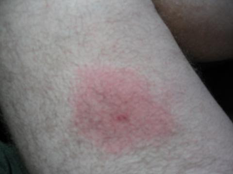Victims of a brown recluse spider bite might feel perfectly fine — until a burning pain described by most patients as a throbbing fire strikes 24 hours later, according to a new study. Ramblings Of A Simple Man Itsy Bitsy Spider