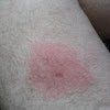 What Does A Brown Recluse Spider Bite Look Like After 24 Hours / My Friends Kitten Was Bitten By A Brown Recluse This Is One Day After Wtf - Although all spiders are different, spider bites do share some common symptoms.