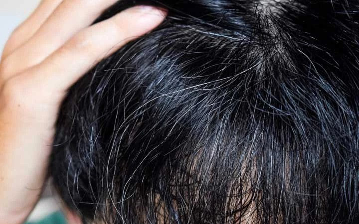 White hair—and by this, we mean hair that's dyed white blonde and not hair naturally white with how long it has to sit on your strands largely depends on your current shade, but rest assured you'll looking for more hair color ideas? How To Reverse Your Premature Grey Hair With Ayurveda Vedix