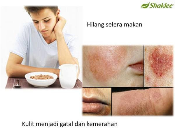 Shaklee Ubat Mati Pucuk - Berubat n