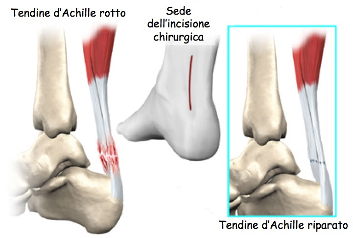 Rottura Del Tendine Di Achille E Protocollo Riabilitativo Fisiosaan