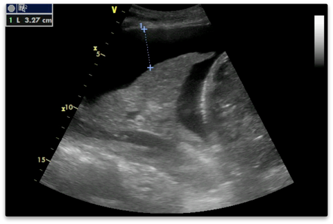 Causes of pleural effusion are generally from it can help decide whether the fluid is free flowing within the pleural space or whether it is contained in a specific area (loculated). Pleural Effusion