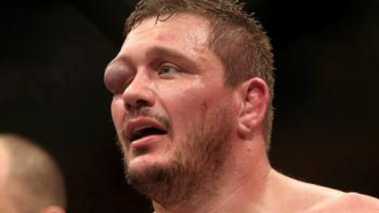 What do you think this fabricio werdum eyes trilogy fight with alistair overeem video? Meathead S Head Just A Swollen Eye No Big Deal Mma Imports