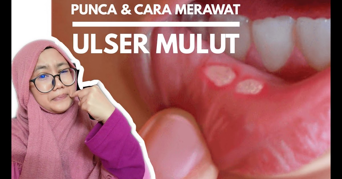 cara hilangkan ulser mulut