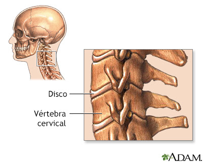 La cirugía puede ser necesaria para reducir la. Vertebras Cervicales