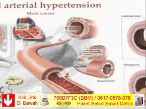 Obat Penurun Tekanan Darah Tinggi Resep Dokter  13 Jamu
