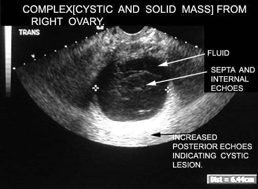 I had my transvaginal ultrasound today. Ovarian Tumors What Is The Clinical Setting When You Will Consider An Ovarian Mass You Would Consider An Ovarian Mass In Any Woman Who Comes In Complaining Of Pressure Symptoms These Symptoms Include Urinary Frequency Pelvic Discomfort And