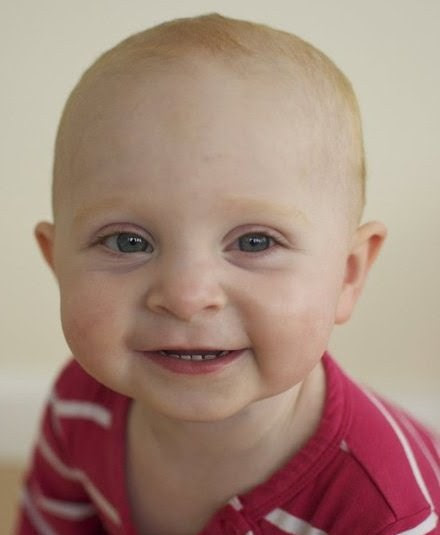 Still, cancer is the second leading cause of death in children younger than 15 years old, after accidents. Patient Signs Symptoms Of Childhood Cancer