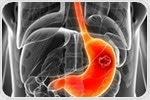 Bug that causes stomach cancer may increase risk of colorectal cancers