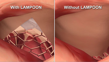 The LAMPOON technique splits the heart valve leaflet (left) so that it doesn’t block blood flow (right). 