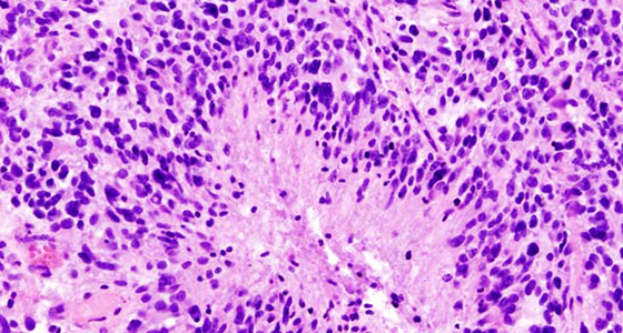 Histopathological image of cerebral glioblastoma. Hematoxylin & esoin stain.